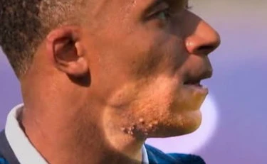 Kylian Mbappè, il pesante sospetto su quelle bolle in faccia