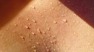 Sudate troppo? Ecco quando bisogna preoccuparsi e quali sono i rischi 