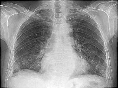 E' previsto intorno al 2025 il picco di manifestazione della malattia da asbesto