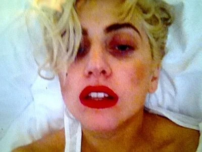 Lady Gaga al risveglio dopo l'incidente di Auckland. Autoscatto su twitter