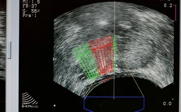 Tumore alla prostata, la nuova terapia che rivoluziona la battaglia