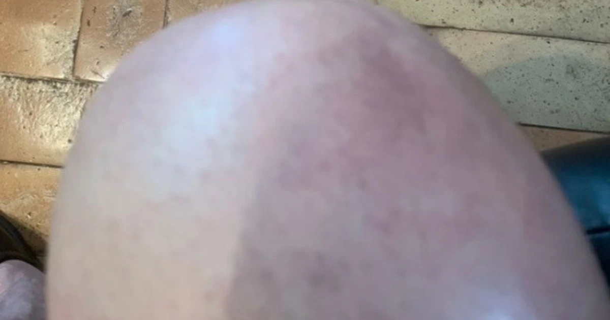 Francesco Storace, sfottò a Roberto Burioni: "Davvero si ritira dalla tv? Il mio ginocchio alla Patria"