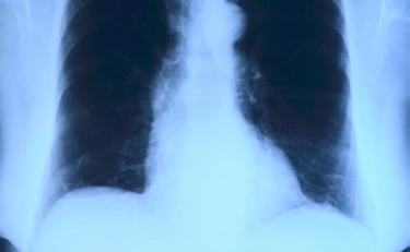 Cancro ai polmoni, l'infiammazione che anticipa la malattia