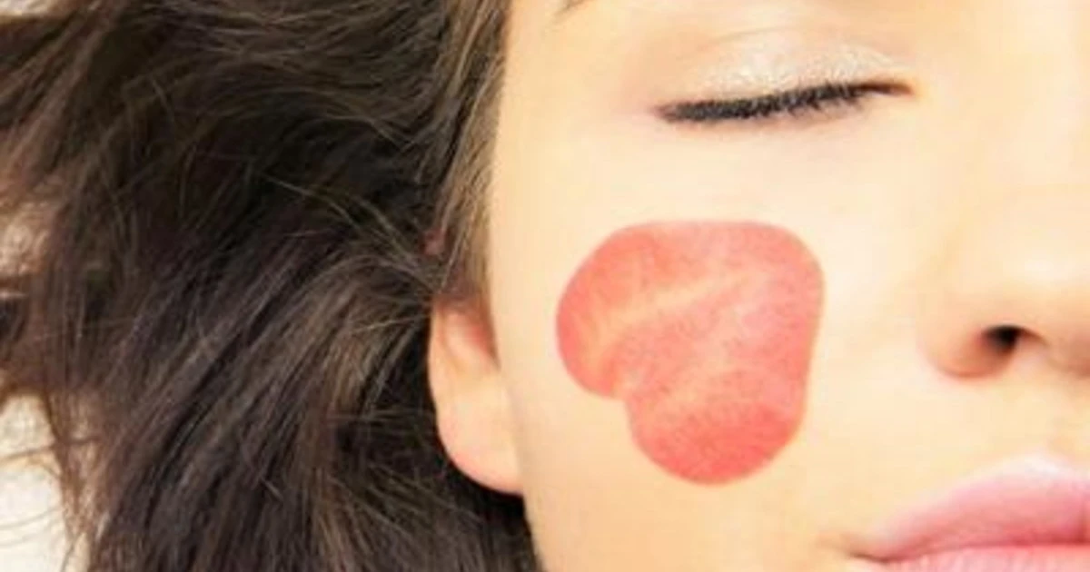 Farmaci: Abbvie, da Aifa ok rimborsabilità nuovo anti-psoriasi