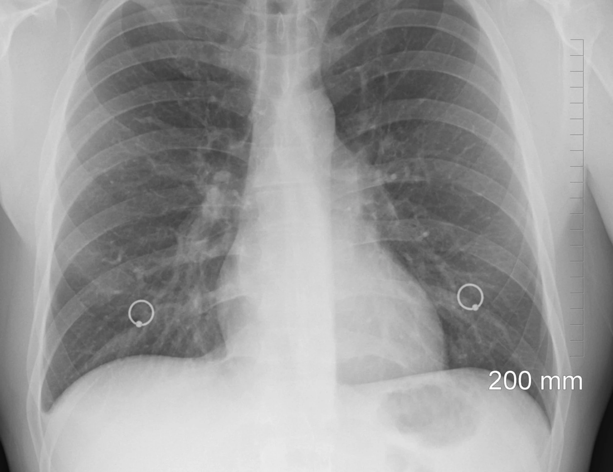Cancro, il rischio schizza per chi è single: ecco le cifre