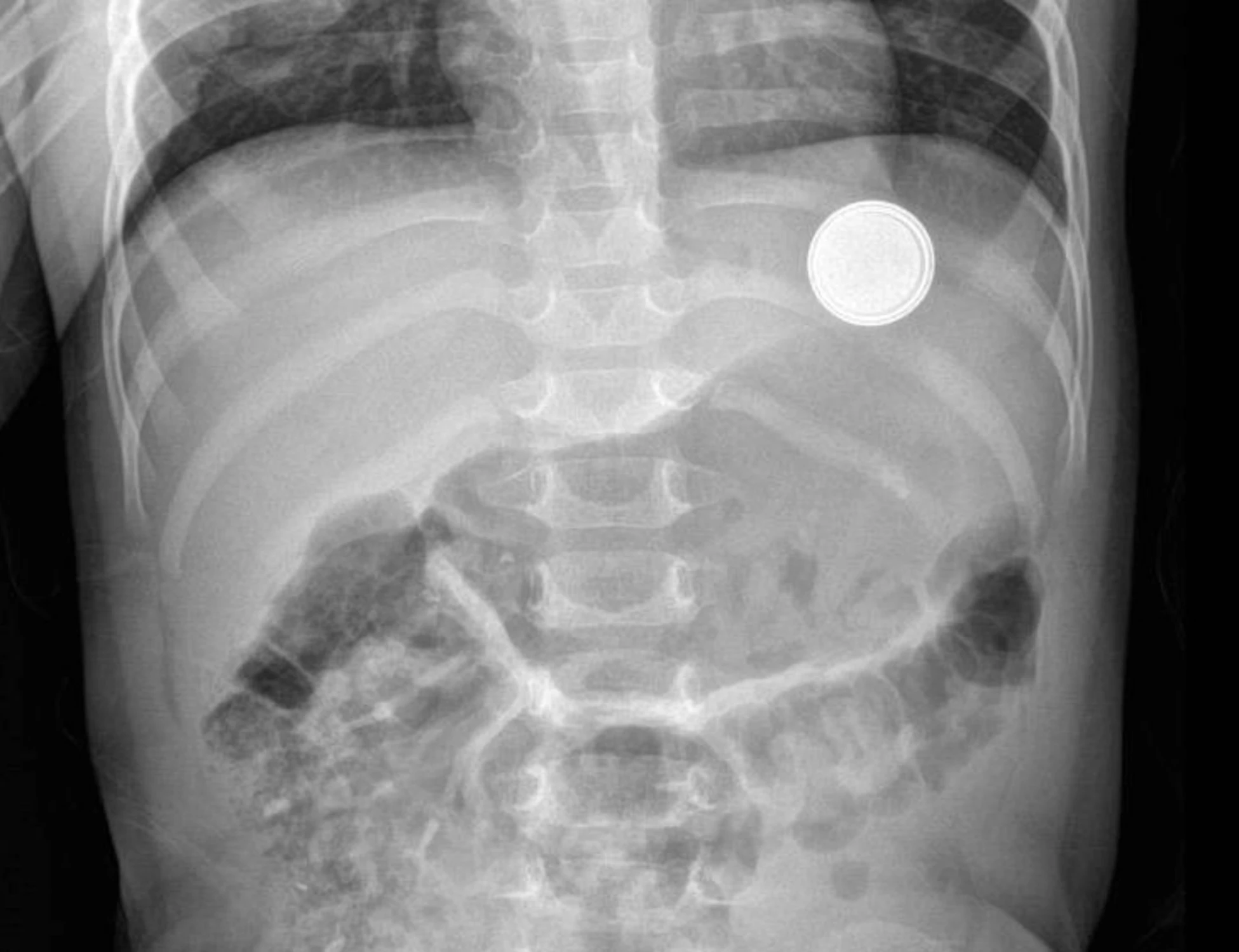 Pile al litio ingerite, 12 casi in 18 mesi: perché è un'emergenza medica