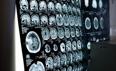 Tumore al cervello e testosterone, il legame: allarme per gli uomini