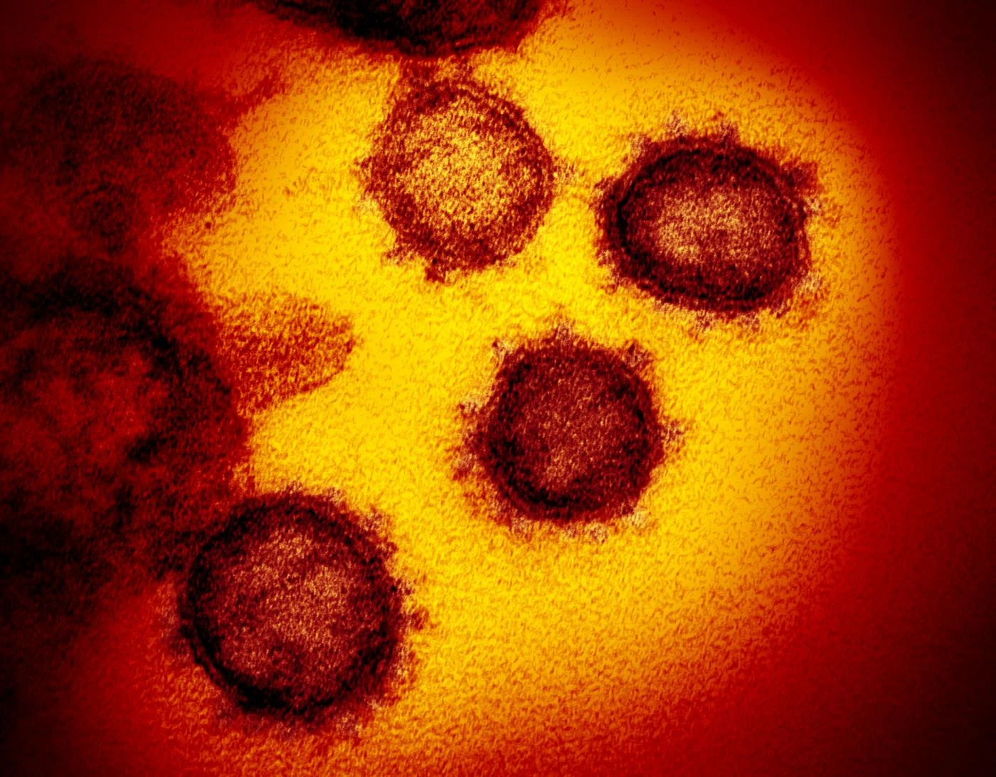 Coronavirus, contagio a Piacenza: una donna 82enne residente a Codogno