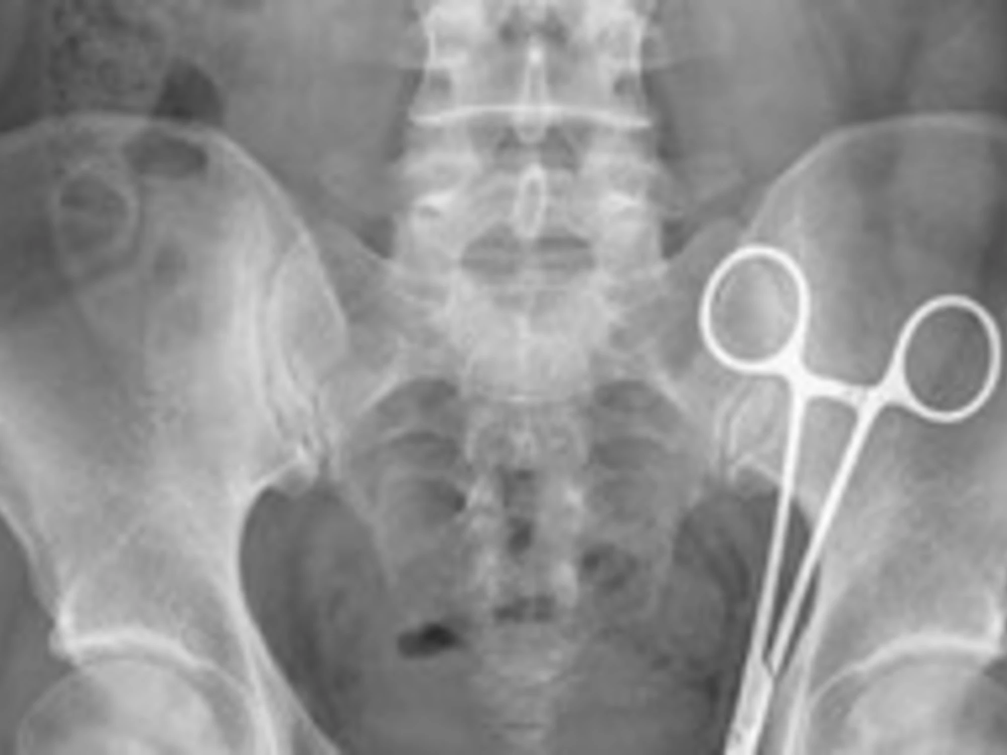 Napoli, sette mesi di dolori lancinanti. La scoperta: cosa c'era dentro al suo corpo