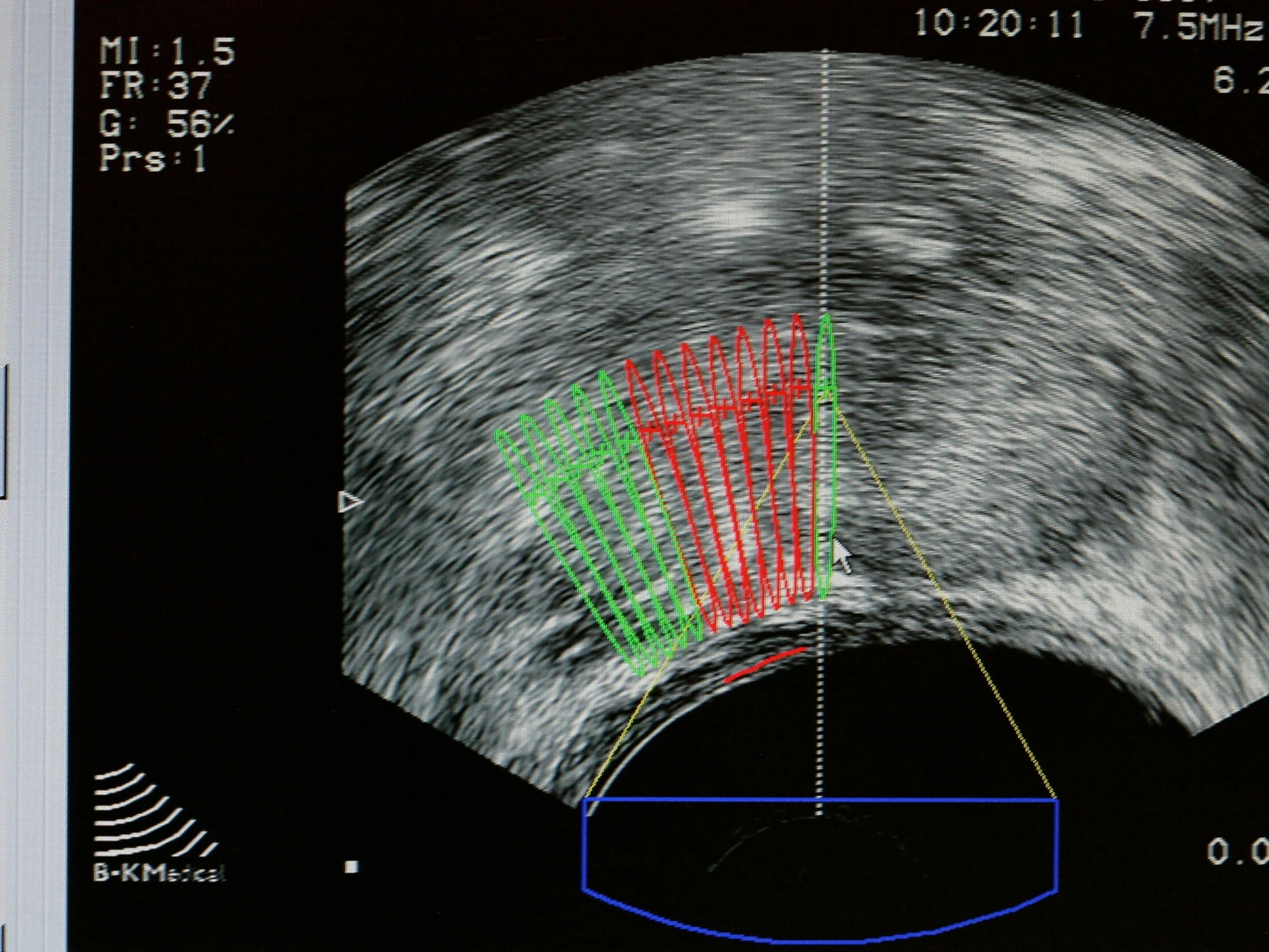 Tumore alla prostata, la nuova terapia che rivoluziona la battaglia